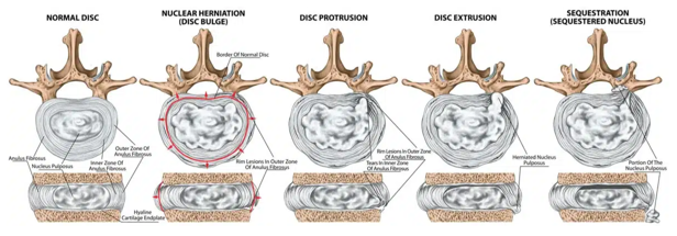 hernia-types