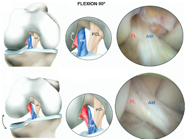acl-pcl