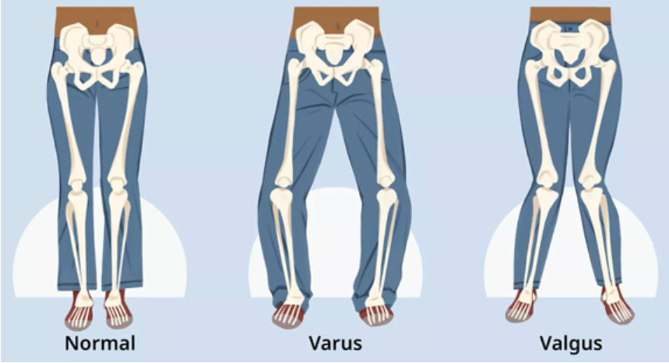 valgus-varus